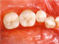 Inlays nachher